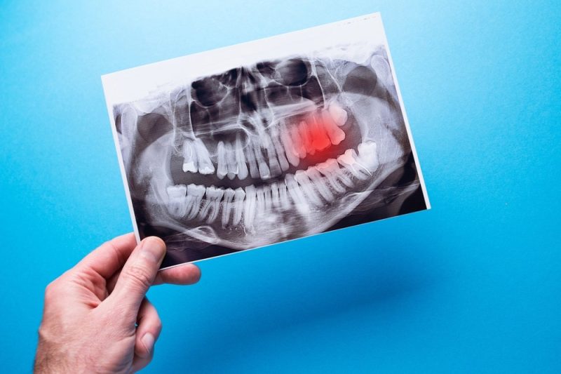 Wisdom teeth x-rays